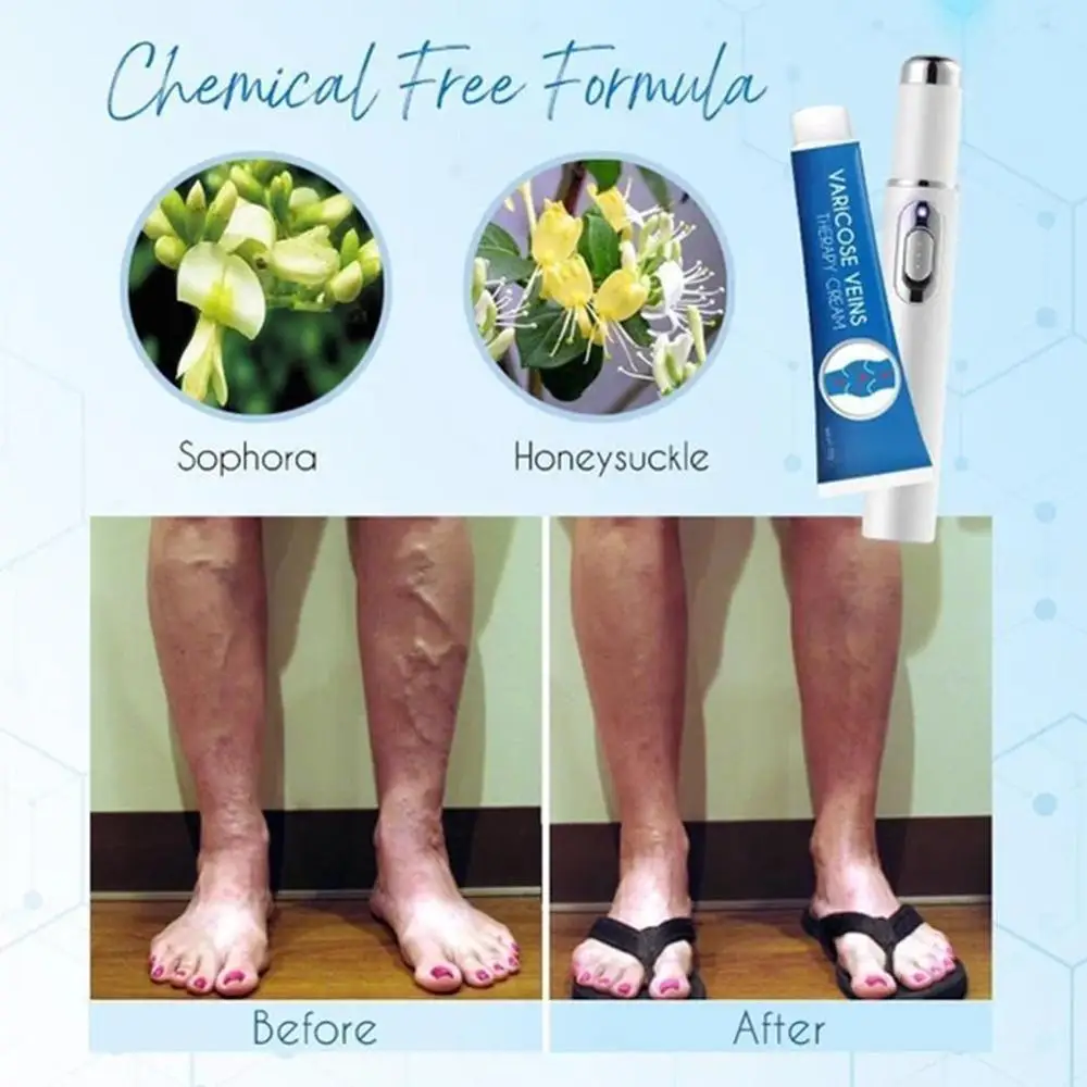 

Blue Light Therapy Pen For Varicose Veins Therapy Pen Soothing Varicose Pen Treatment Acne Pen + Vein Cream D3U0