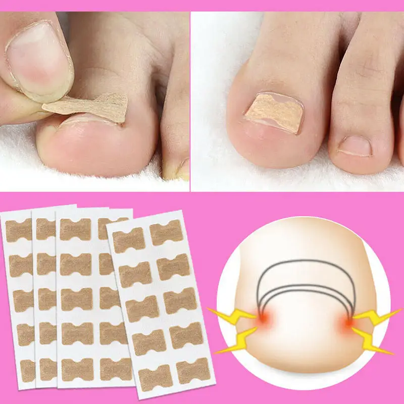 Коррекция ногтей наклейки вросшие ногти для ног &quotфранцзуский маникюр&quot
