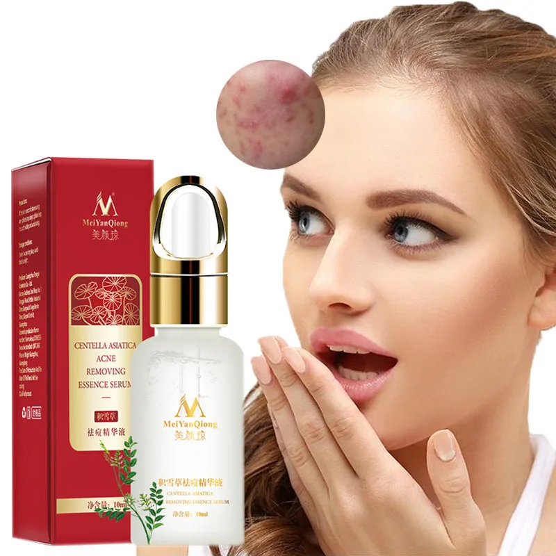 Лечение акне уход за кожей лица Сыворотки центеллы азиатской масляный