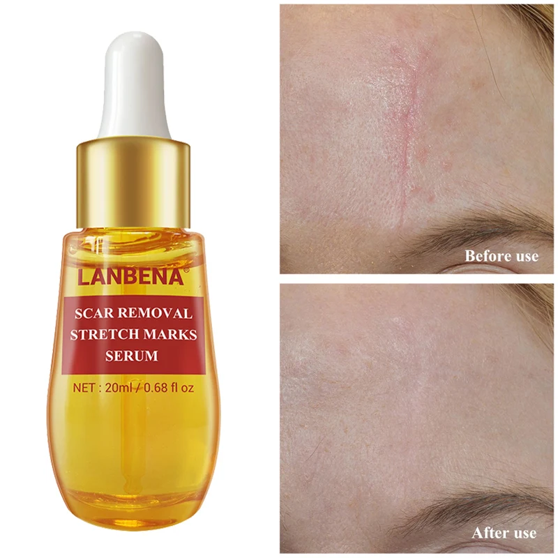 

LANBENA 20 мл лечение шрамов уход за кожей лица Сыворотки уменьшение угревой сыпи и акне пятна корректор пигментных пятен анти-шрам увлажняющий ...