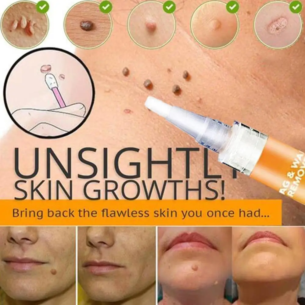 Крем для лечения бородавок устройство удаление Антибактериальная мазь удаления