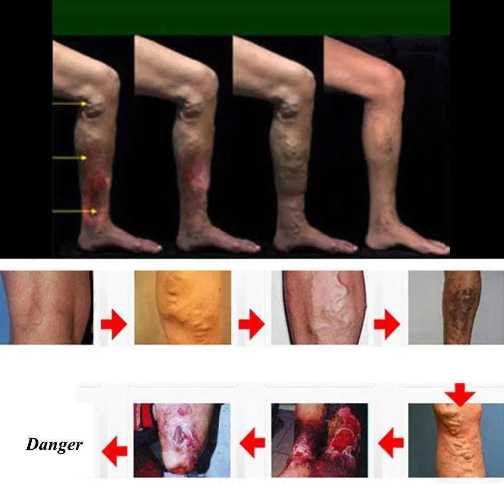30 мл Крем для лечения варикозного расширения вен мазь васкулит ангиит флебит