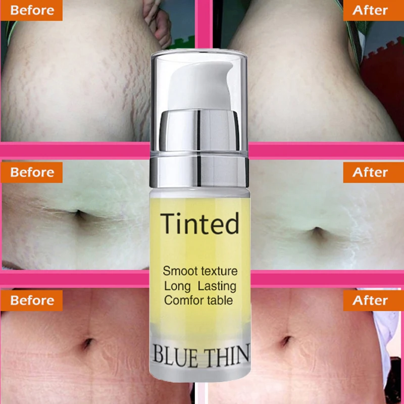 

Mild Non-irritating Stretch Mark Removal Cream for Pregnancy Scar Repair Slack Line Abdomen Stretch Marks Creams women Skin Care