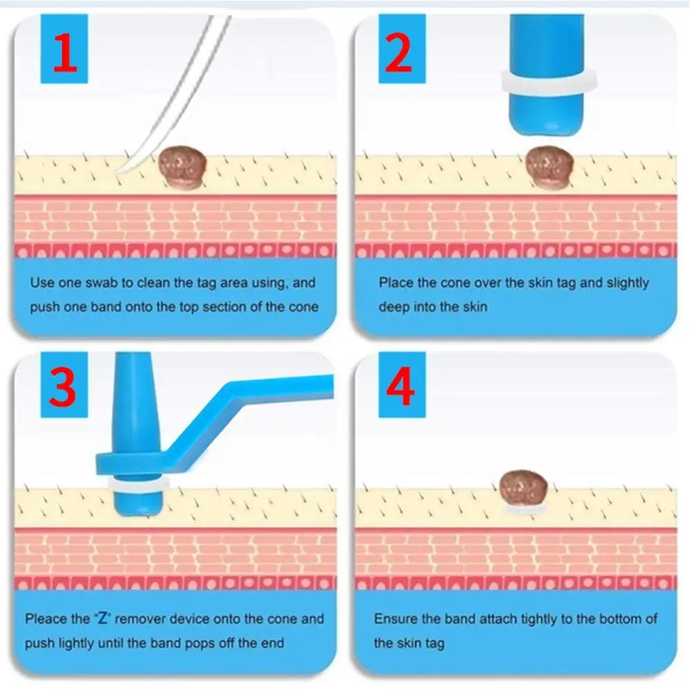 

Medical Skin Tag Kill Skin Mole Wart Remover Micro Band Skin Tag Removal Kit With Cleansing Swabs Adult Mole Wart Face Care