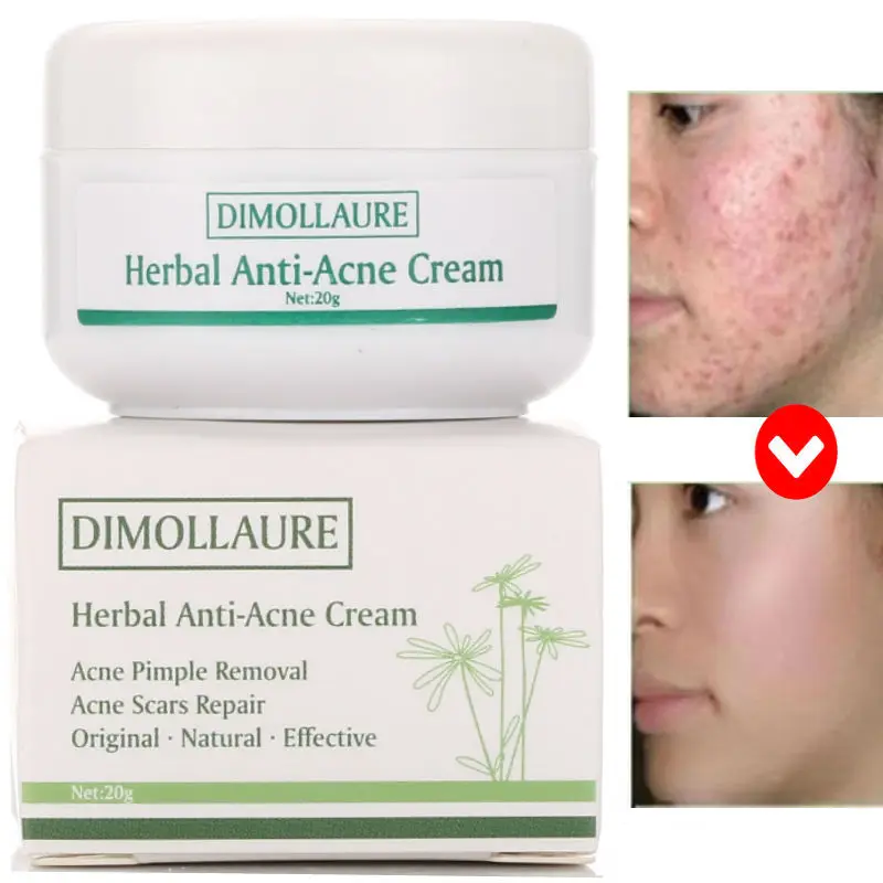 Dimollaure крем для лечения акне увлажняющий против рубцов от отбеливает кожу