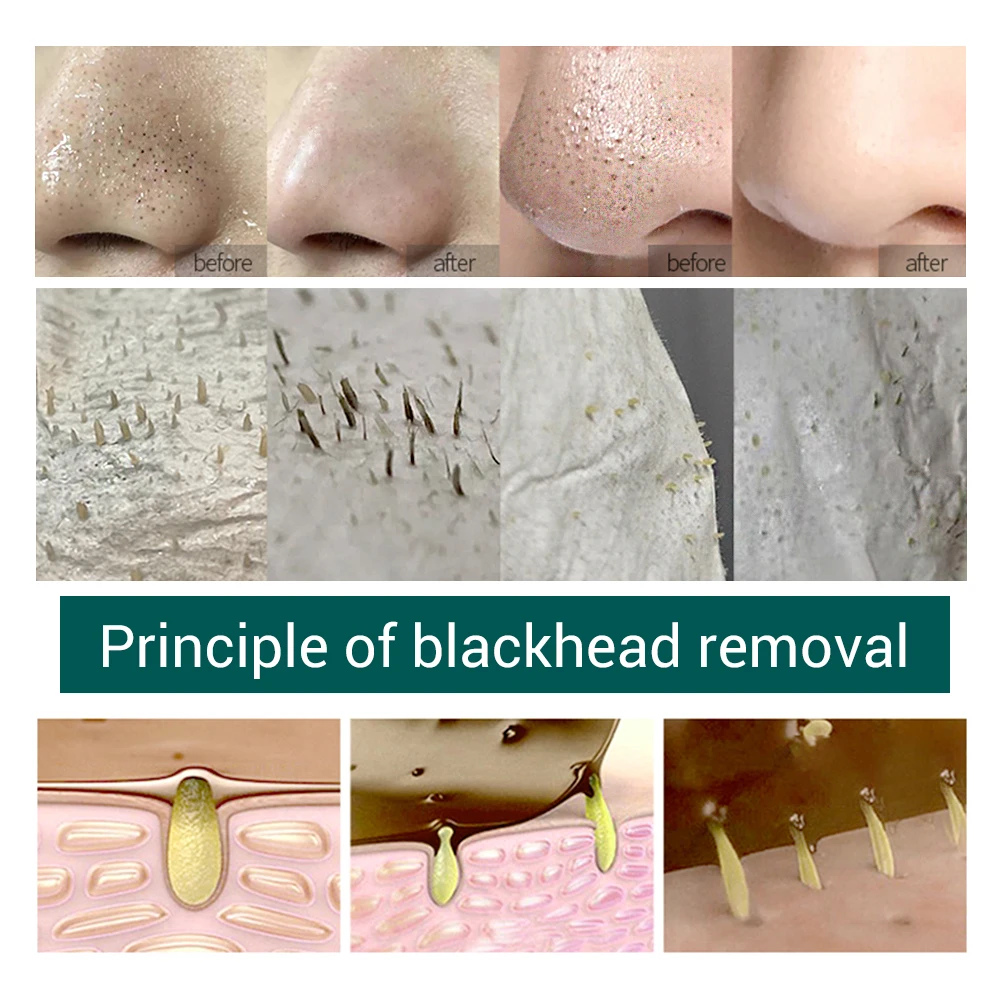 SOONPURE Blackhead Removal Facial Nose Mask Black Masks Pore Strip Pores Shrink Firming Serum Pimple Acne Treatment Skin Care