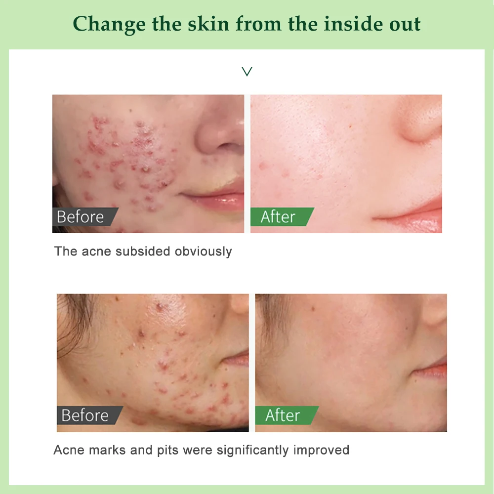 Пятна Отбеливание акне крем Женский гель для лица Восстанавливающий выцветающий