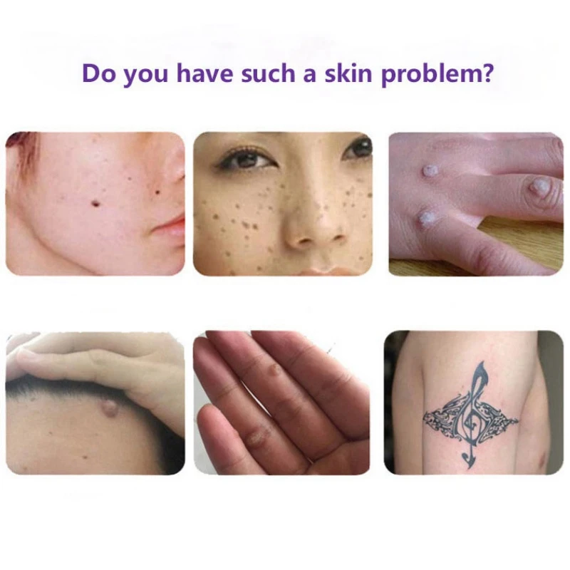 2 шт. эссенция для удаления пятен на коже веснушек и пятен| |