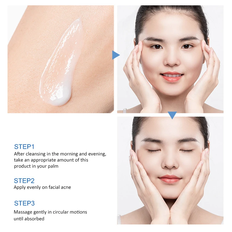 Acne Treatment Face Cream Blackhead Repair Gel Oil Control Shrink Pores Scar Whitening Moisturizer Skin Care Cosmetics