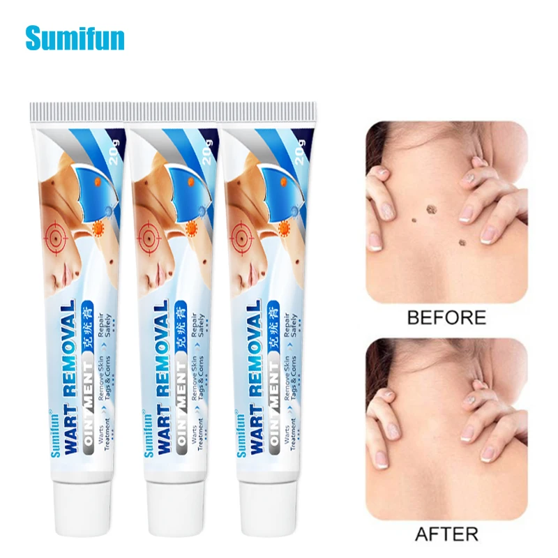

3Pcs Sumifun Skin Tag Remover Creammicro Warts Treatment Antibacterial Ointment Herbal Extract Plaster Skin Care