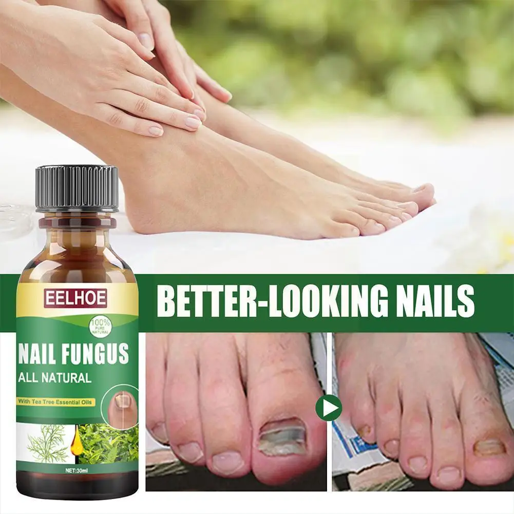 

Nail Fungal Treatment Care Essence Nail Foot Whitening Infection Paronychia Anti Removal Nails Fungus Gel Onychomycosis B1t6