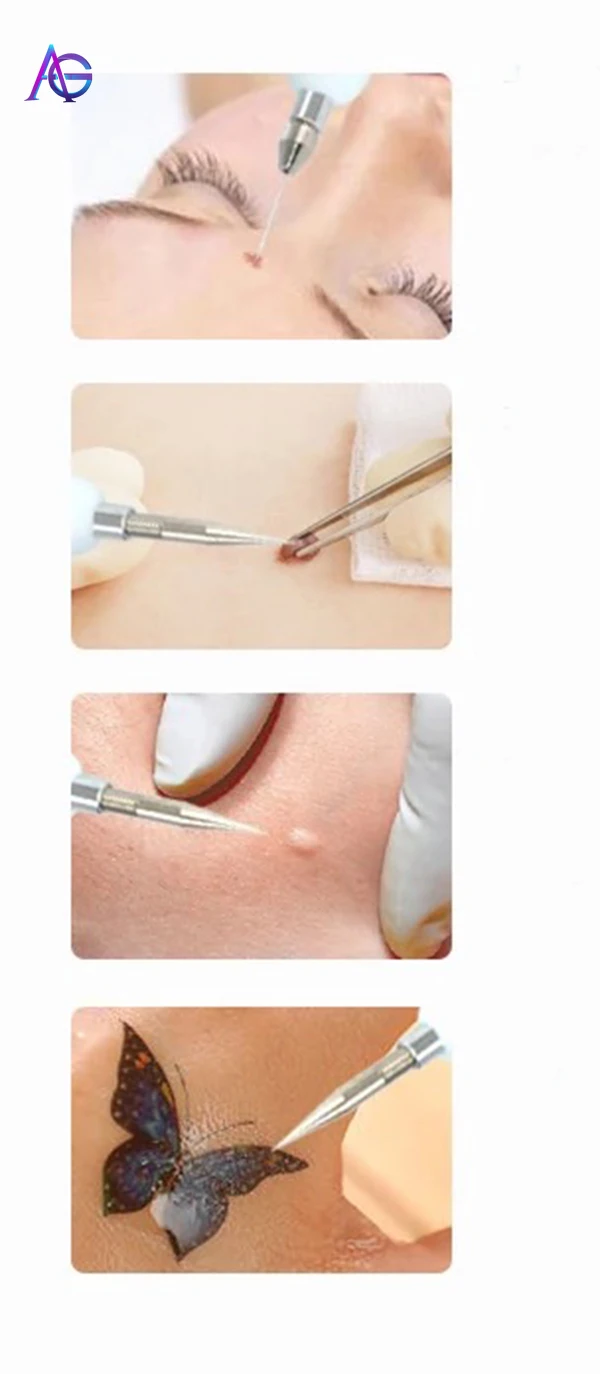 

Point Pla sma pen German technology spot pen ion meter for Freckle, sputum, tattoo removal