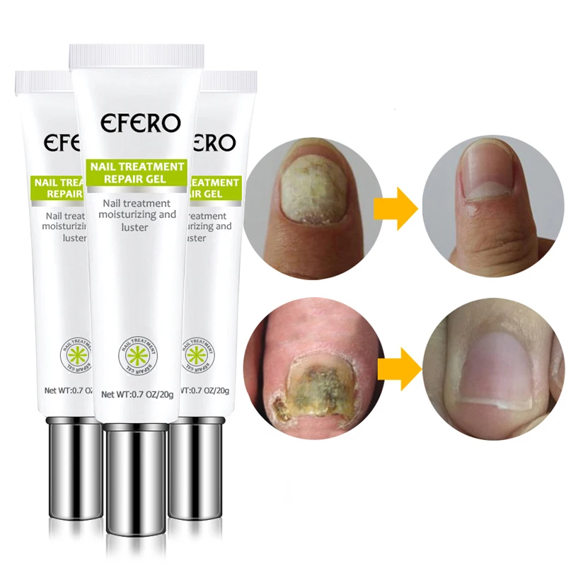 

Nail Repair Gel Anti-Fungal Nail Essence Care For Fingers And Toes Treat Serum Onychomycosis Repair Hands Feet And Nails Health