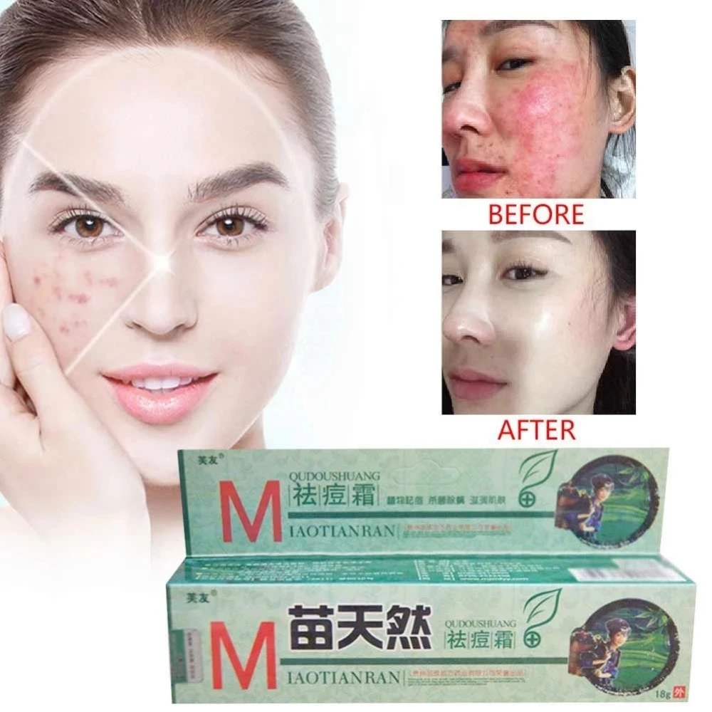 

1/3Pcs Original MIAOTIANRAN Remove Acne Cream Germicidal Remove Mite and Moisturize Your Skin for Facial Treatment Skin Care