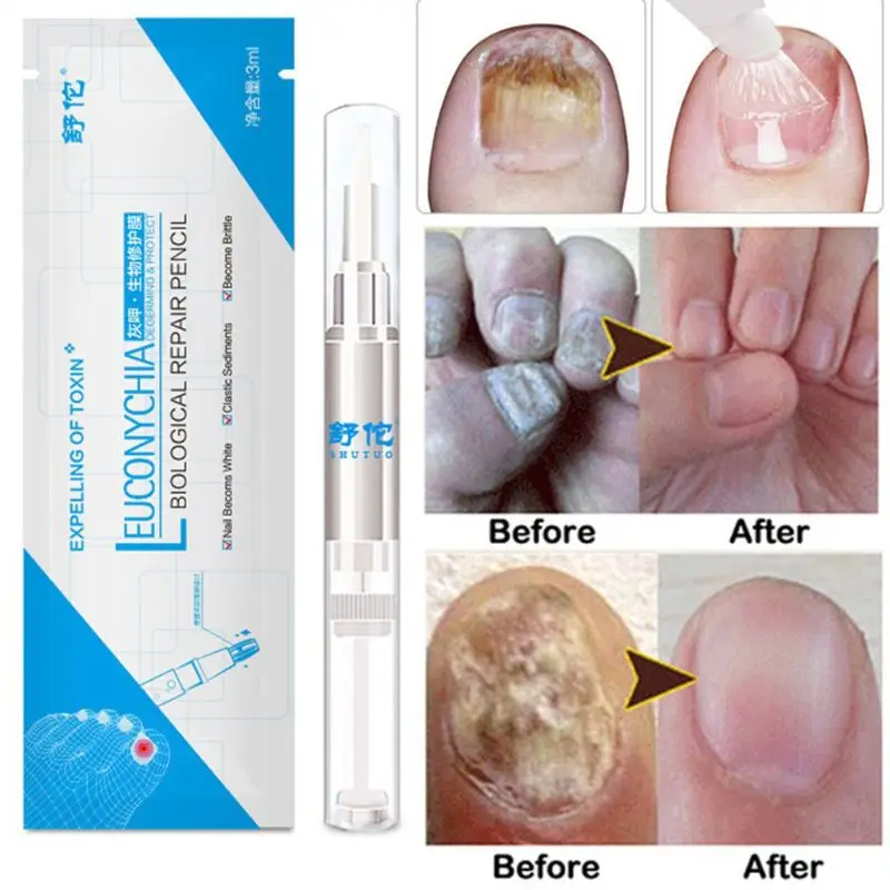 

3ml Fungal Nail Pen Effective Onychomycosis Paronychia Fungus Infection Repair Solution Gel Toenail Treatment Nutrient Essence