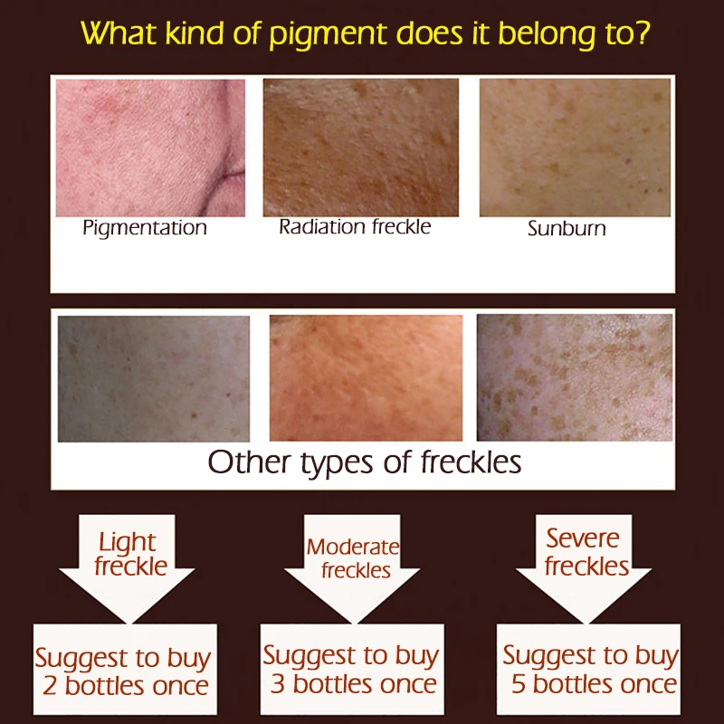 Травяной отбеливающий крем для лица с веснушек витамин С антивозрастной против