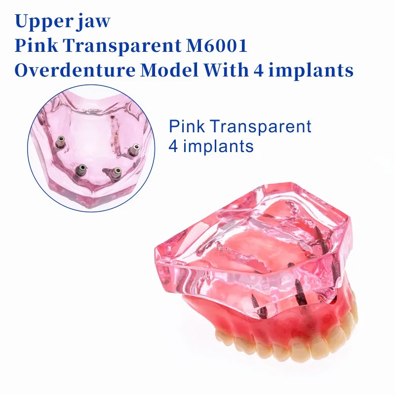 Верхняя челюсть зубного протеза внутренняя с 4 имплантатами Восстановление