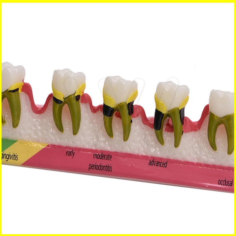 Демонстрационная модель зубного кариеса обучения методонтическое
