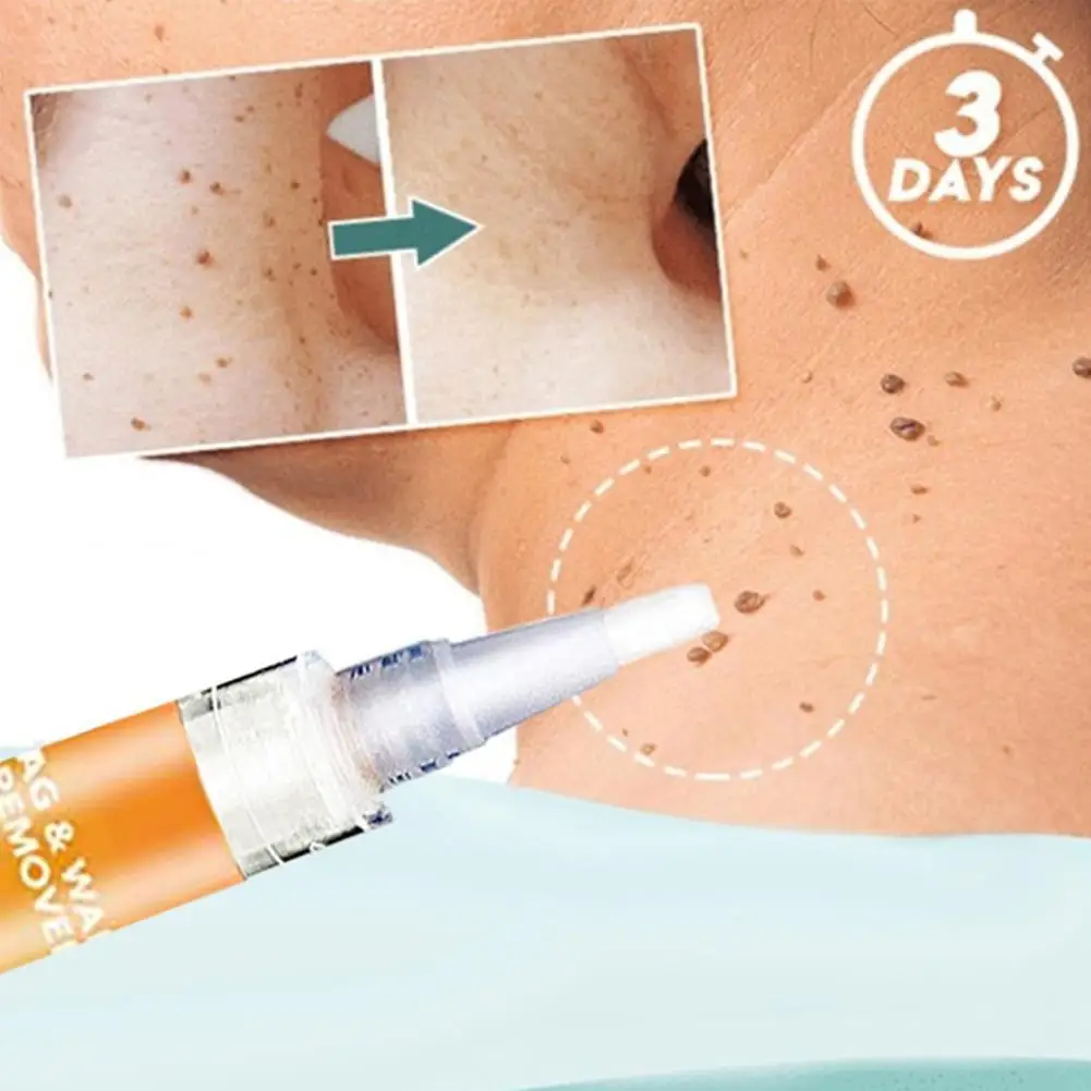 

1/2Pcs 3Ml Body Warts Treatment Liquid Skin Tag Remover Foot Corn Removal Plantar Genital Warts Ointment Foot Care Pen