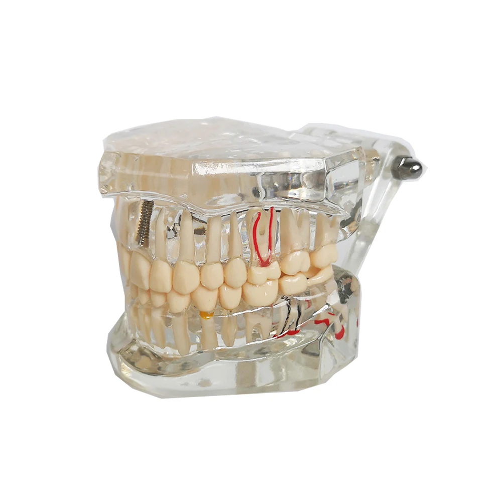 Зубная модель зубной имплантат с реставрационным мостом стоматолог медицинская