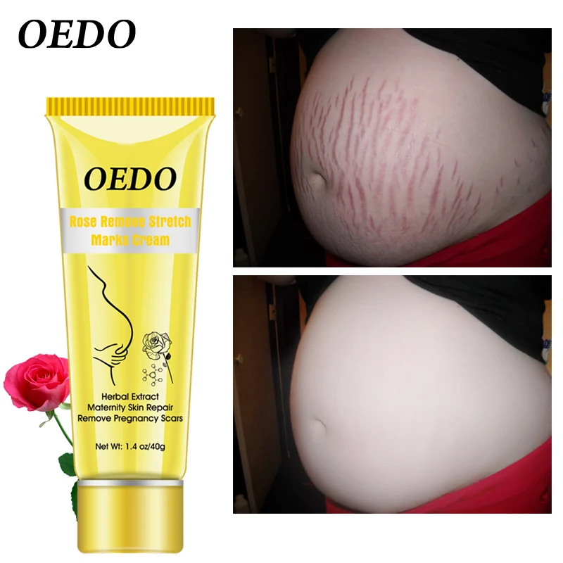 

Pregnancy Scars Remove Stretch Marks Cream Treatment Maternity Repair Anti-Aging Anti-Wrinkles Firming Stretch Mark Body Creams