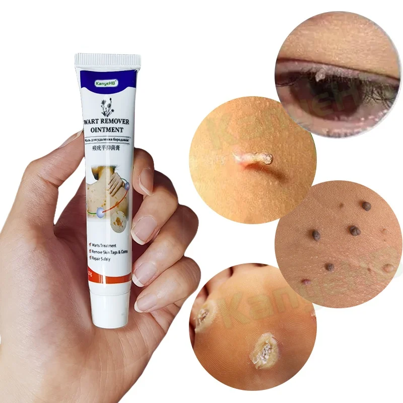

1pcs Wart Removal Ointment Wart Treatment Cream Neck Skin Tag Armpit Flat Wart Genitals Wart Feet Corns Medical Wart Cream