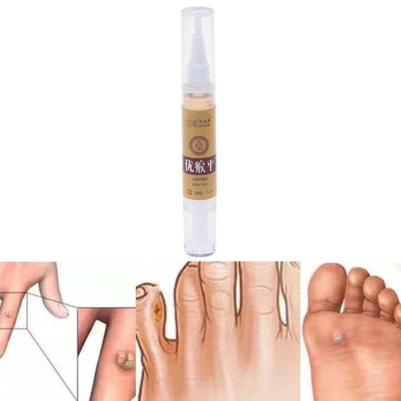 Крем для лечения бородавок на теле 5 мл мазь удаления ногах средство ухода за