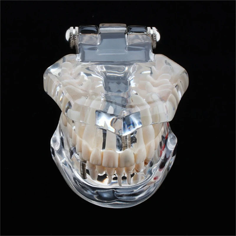 

Hot Dental Implant Disease Teeth Model With Restoration Bridge Tooth Dentist For Medical Science Dental Disease