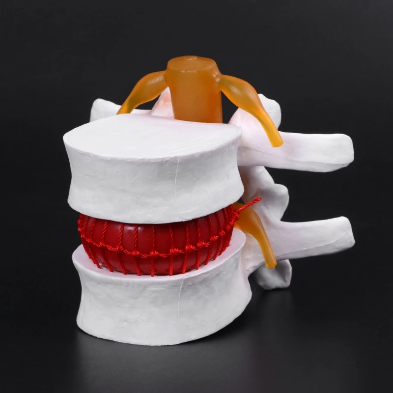 

Human Anatomical Lumbar Disc Herniation Model Learn Aid Anatomy Instrume