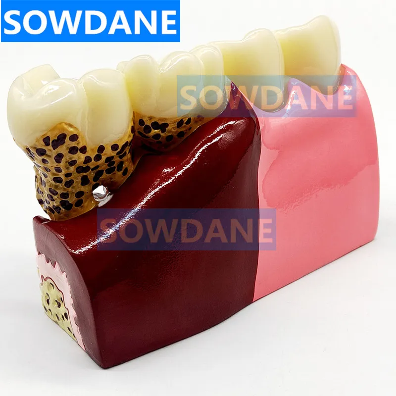 Зубные протезы модель обычной патологии обучающая зубной Стоматолог для изучения медицины