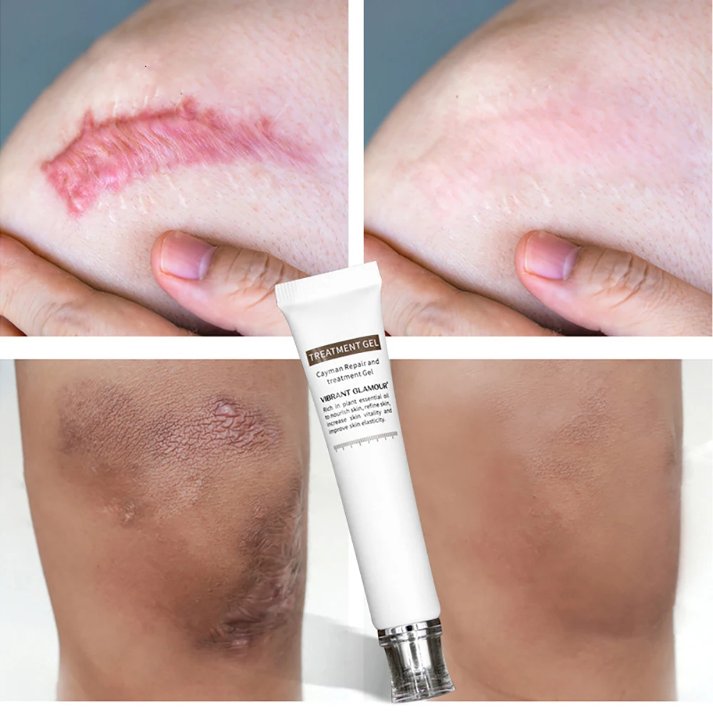 Яркий гламурный восстанавливающий крем для удаления шрамов от акне гель