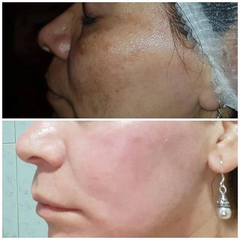 Игла с золотыми микроиглами штыковой картридж 12 иглами нано иглы MYM наконечник