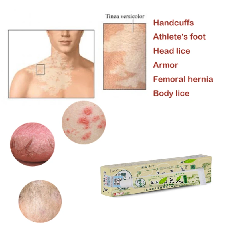 Крем Zudaifu для ухода за кожей от псориаза дерматитов экземы | Красота и здоровье