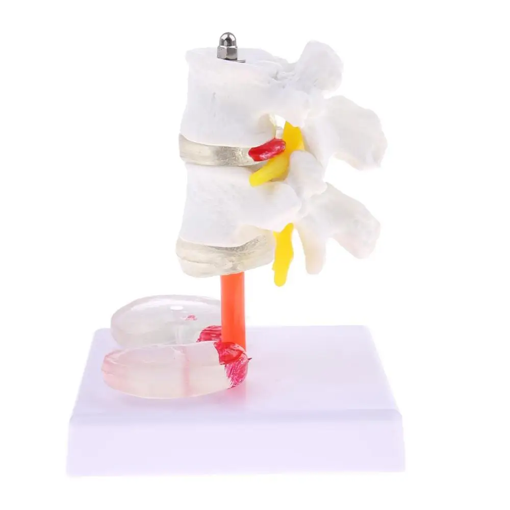 Медицинский Скелет с двумя поясничными позвонками и больным межпозвоночным