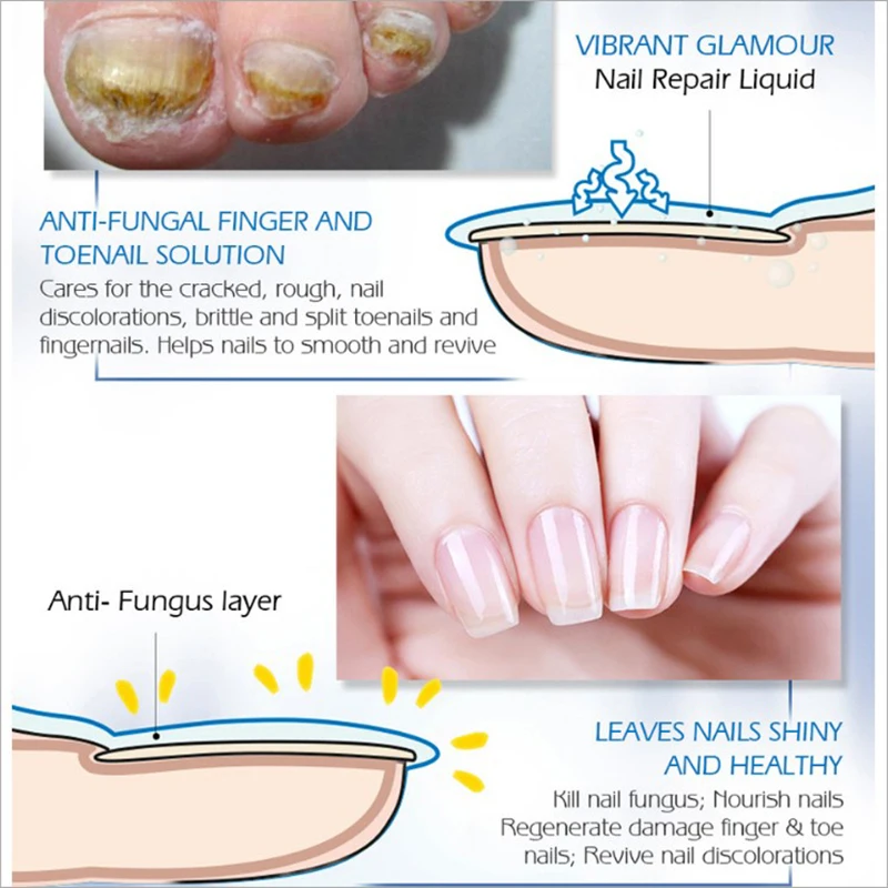 

Fungal Nail Treatment Feet Care Essence Nail and Foot Whitening Toe Nail Fungus Removal Nail Gel Face Skin Care