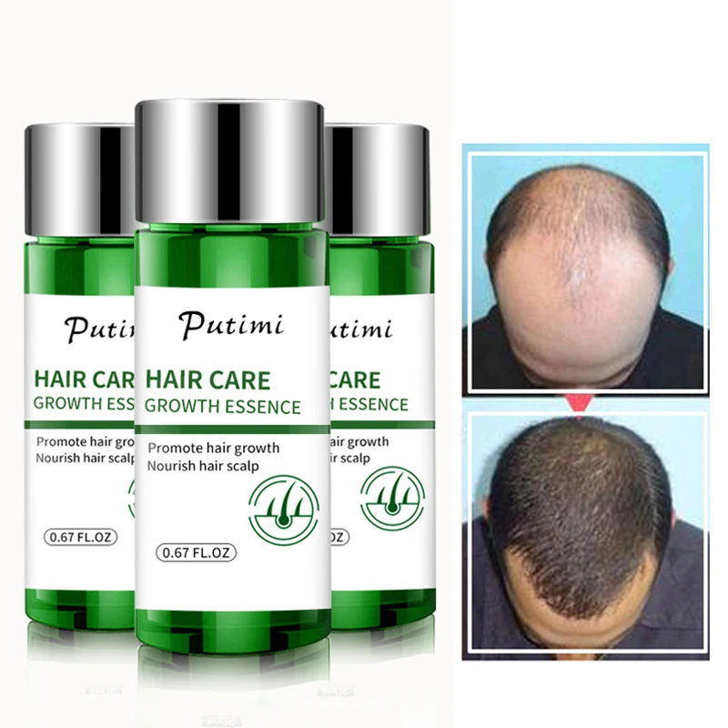 Имбирные эфирные масла для роста волос, стимулирующие восстановление волос, эссенция для предотвращения облысения, выпадения волос, сыворо...