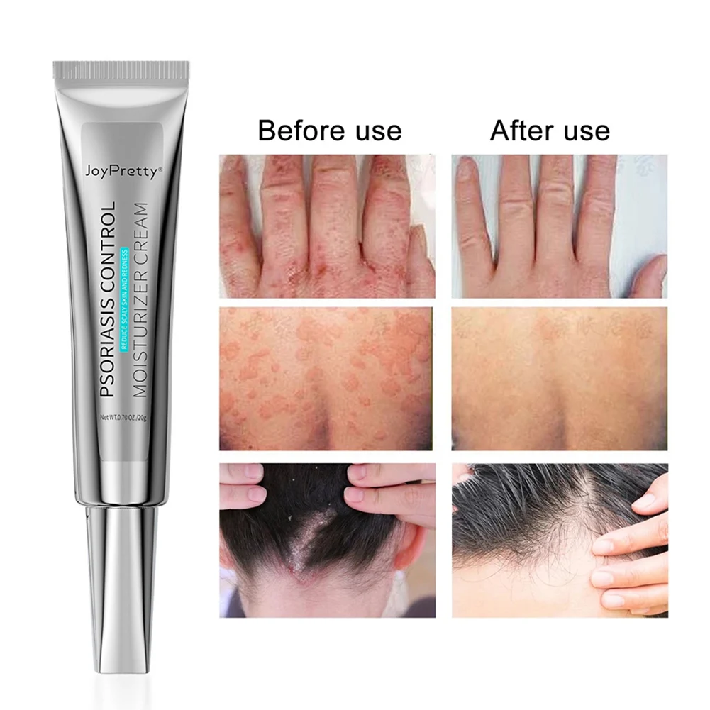 

Herbal Eczema Psoriasis Cream Antibacterial Dermatitis Treatment Anti-itch Relief Skin Rash Irritation Allergies Urticaria Care