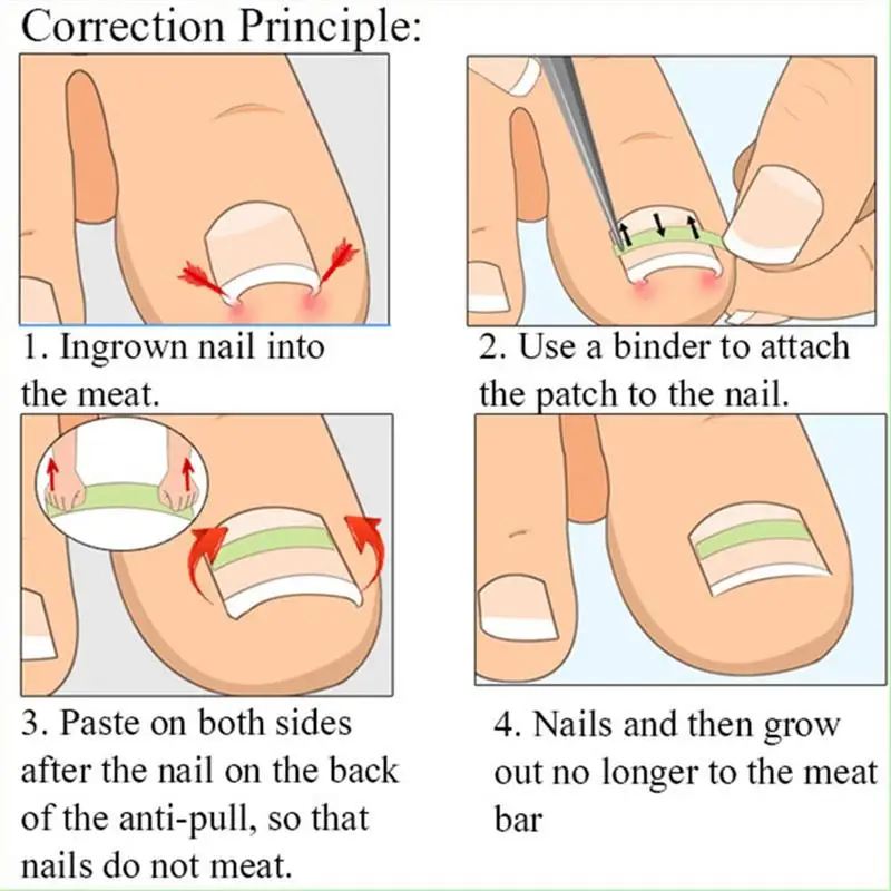 

12/24pcs Ingrown Toe Nail Fixer Pedicure Recover Embed Toenail Correction Lifter Tool Toe nail Straightening Patch Pedicure Tool