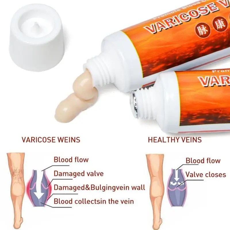 Варикозное расширение вен лечение крем мазь васкулит флебит ангиит воспаление