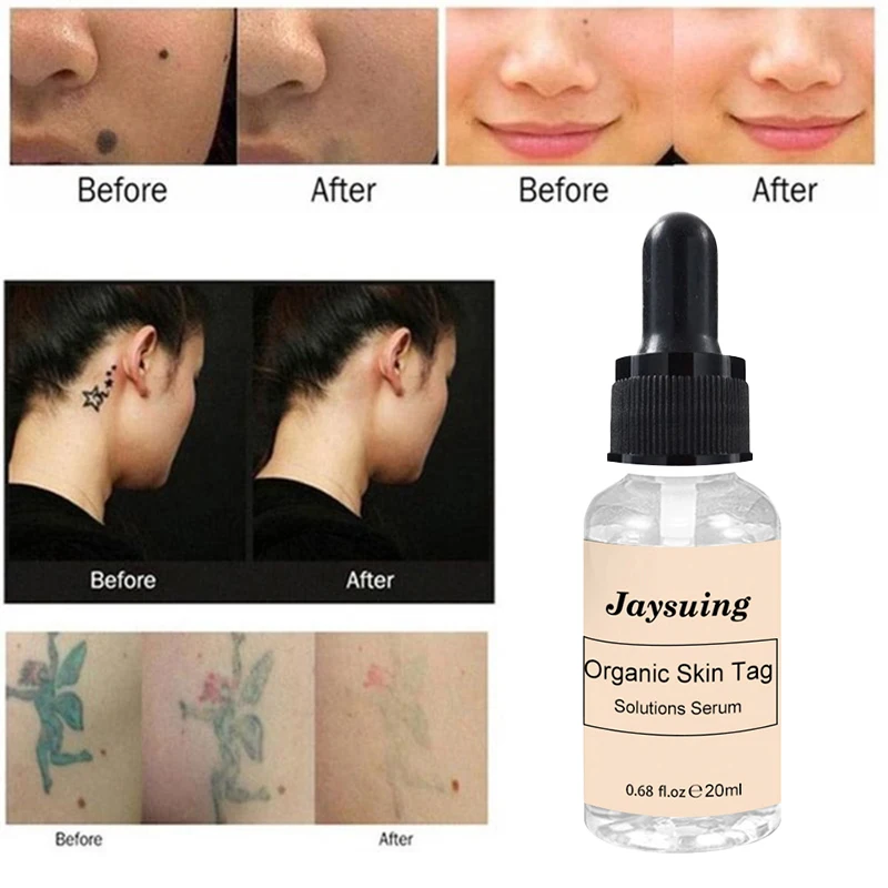 

10/20ML Organic Tags Solutions Serum Skin Tag Remover Serum Painless Mole Skin Dark Spot Freckle Remover Cream Oil Plaster