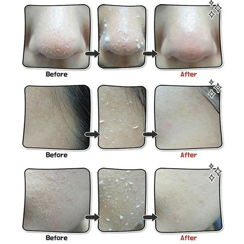 Средство для уменьшения пор от акне женщин пилинг лица гель пилинга мягкий 100 г