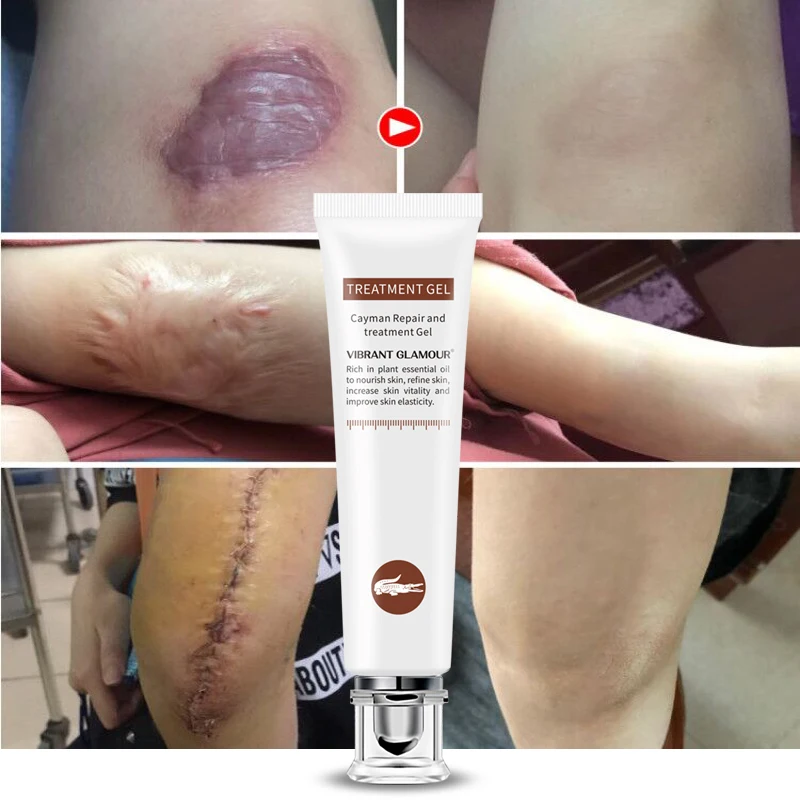 

VIBRANT GLAMOUR Repair Scar cream Removal Acne Scars Stretch Marks CreamSurgical scar Burn For Body Pigmentation Corrector