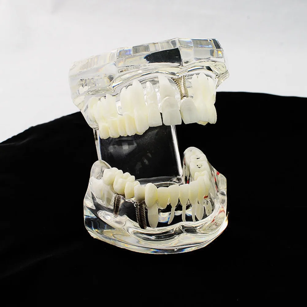 Ремонт стоматологического имплантата физический патологический уход за