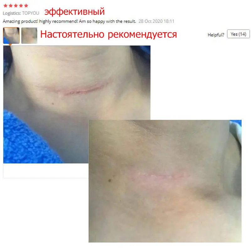 Крем для удаления шрамов от акне гель лица прыщи растяжки крем восстанавливающий