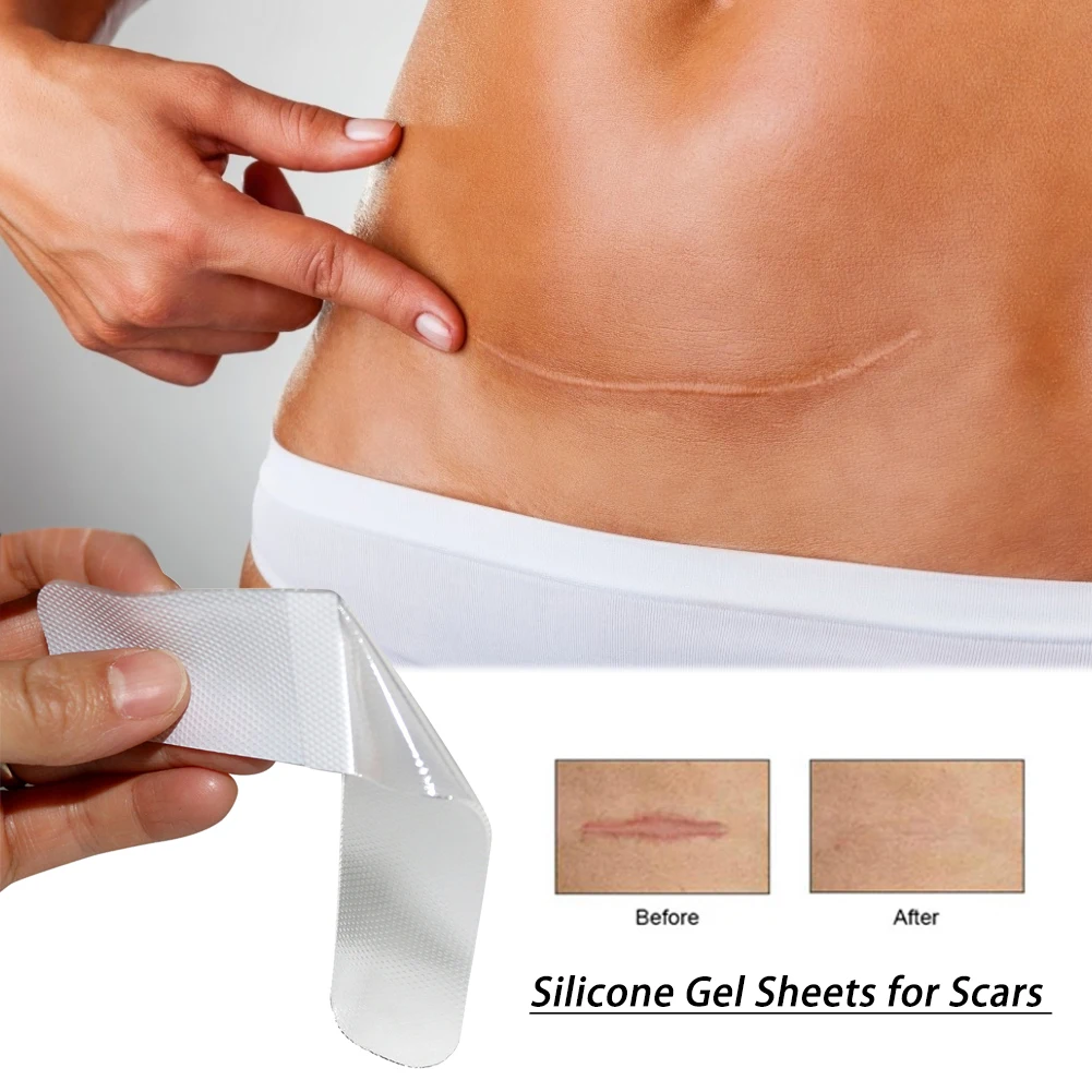 

Silicone Gel Sheets for Scars Single Sheet Scar Cover Medical Grade Scar Treatment Prevents Keloid Hypertrophic Scarring