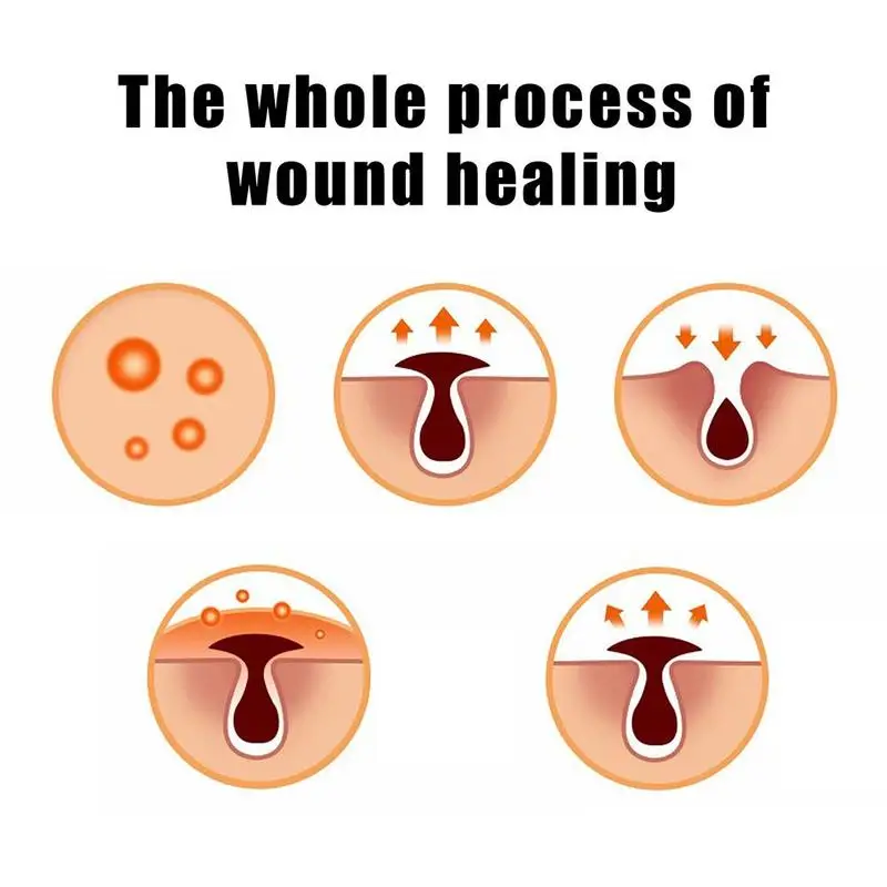 New Acne Scar Removal Cream Face Pimples Maternity Stretch Marks Repair Gel body Smoothing Whitening Moisturizing Skin Care 30g