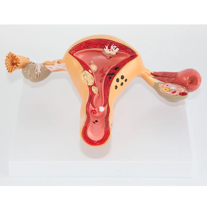 1:1 патологическая матка и яичная анатомическая модель в травмах ортопедическая