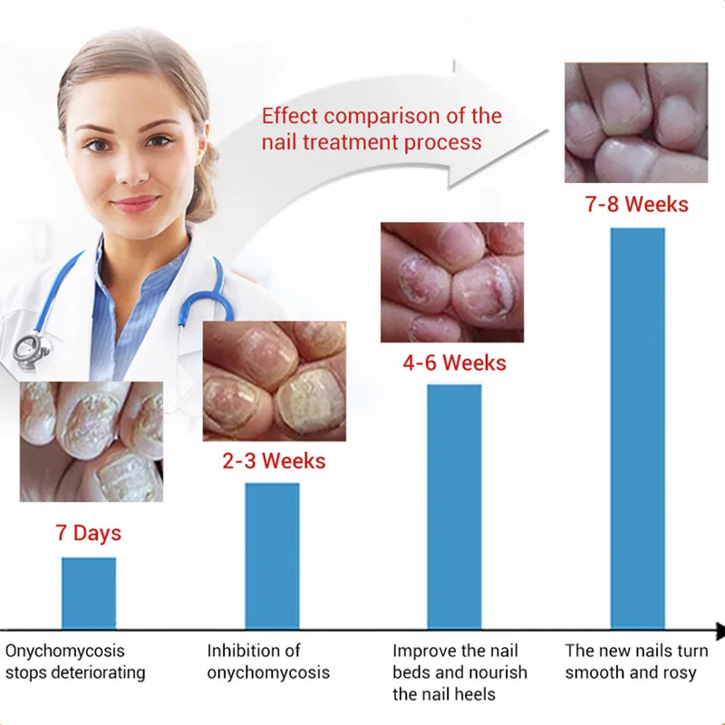 LANBENA Масло для кутикулы питательное Лечение грибка ногтей Onychomycosis Remendy Сыворотка