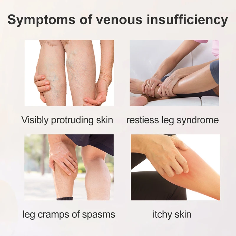 

10ml Varicose Veins Treatment Herbal Oil For Vasculitis Phlebitis Blood Vessel Spider Legs Angiitis Medical Oil Legs Care