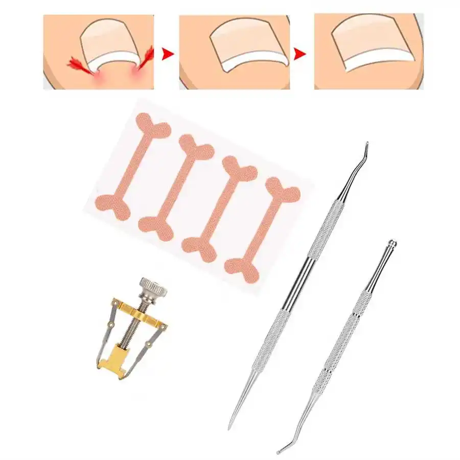 4 шт. фиксатор для вросших ног и педикюра | Красота здоровье